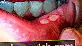 Zahnfleischkrebs Wunden