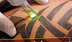 Laser zum Löschen eines Tattoos
